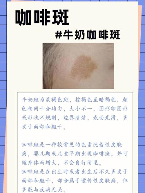 “咖啡牛奶斑”精准激光治疗效果好(激光牛奶咖啡)