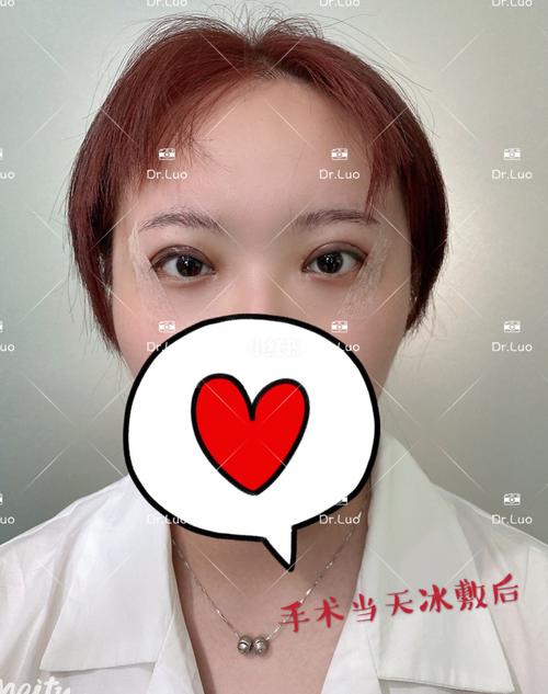 成都八大处助力“睡眠女孩”圆梦 重度上睑下垂修复手术顺利完成(恩恩下垂手術)