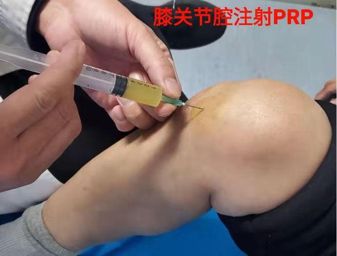 关节疼痛的新救星——PRP(註射治療血小板)