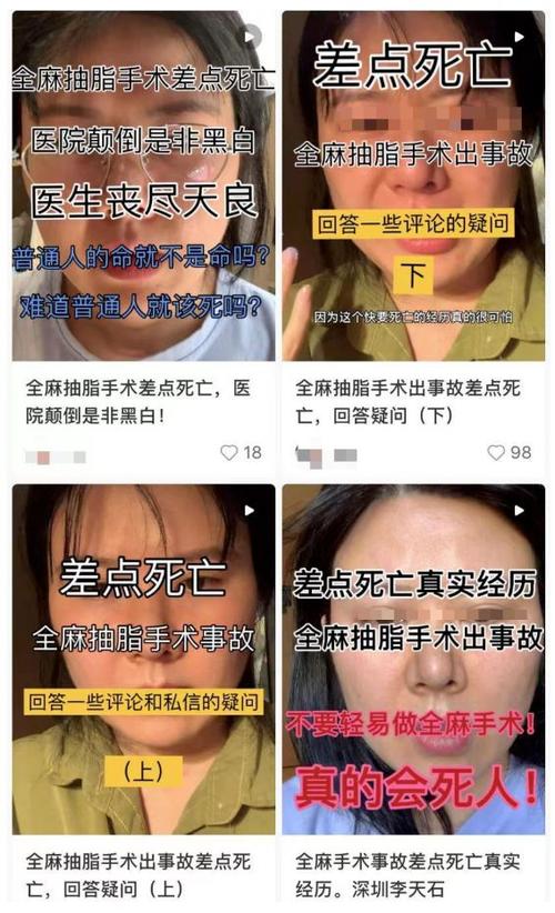 网红感染去世背后_抽脂乱象有多少？(抽脂手術術後)