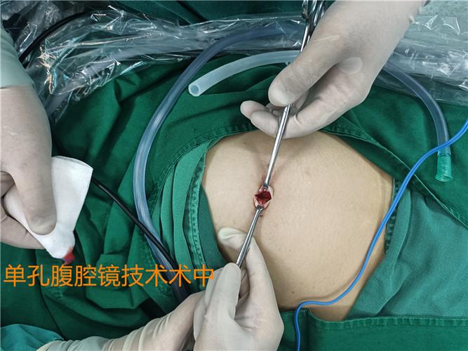 吉大二院妇科单孔腹腔镜诊技术挺近“无痕”手术新时代(手術腹腔鏡婦科)