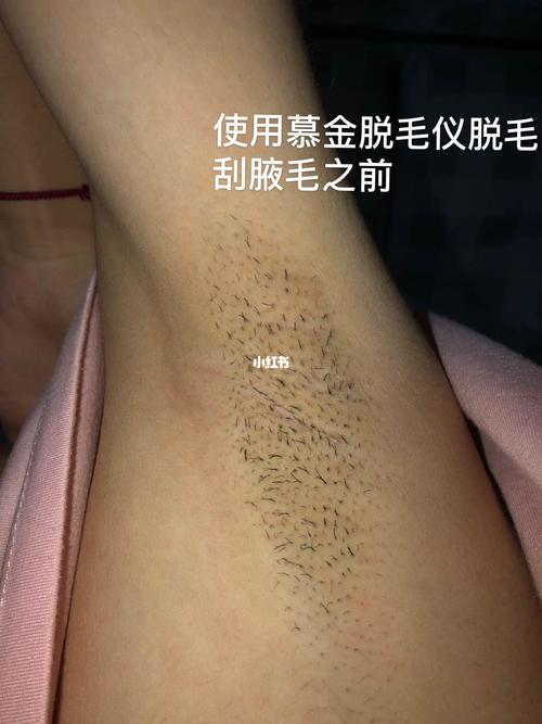 唯品会上3折买到大牌脱毛仪_揭秘使用三次后的效果(脫毛很多人毒物)