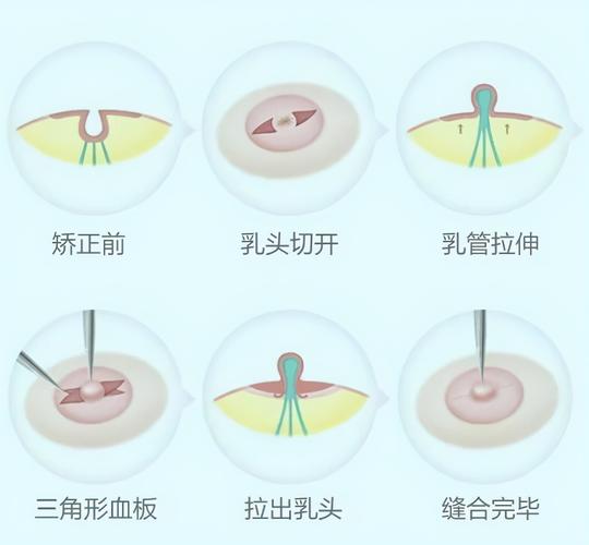 乳房整形您知道多少呢？(乳房整形乳頭)