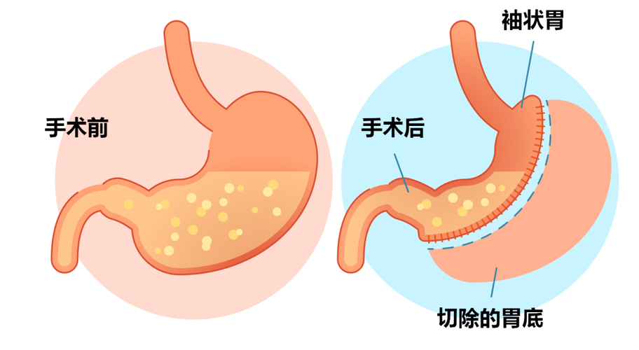 一年10000例！“切胃减肥”被滥用还是切得不够？(手術代謝患者)