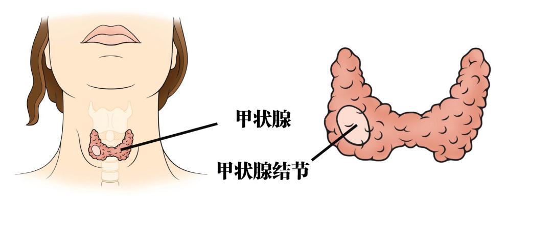 4月30日直播片断(交感神經結節甲狀腺)