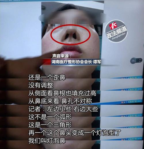 长沙德尔美客美容院又把人鼻子整歪了_用的都是些不明来路的药和(都是德爾來路)