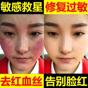 名门泽佳：脸部化妆品过敏怎么办 有效改善过敏的方法(過敏化妝品皮膚)