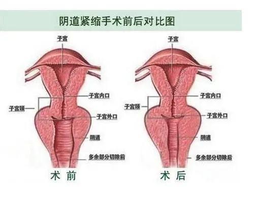 美容院里的妇科诊所：缩阴?让您“紧紧”抓住“幸福”(陰道縮陰讓您)