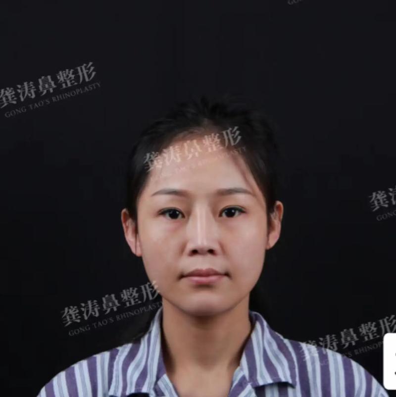 这个广西女子很郁闷：隆鼻没做好_整鼻修复要等_要求退款遭拒(修復之星軟骨)