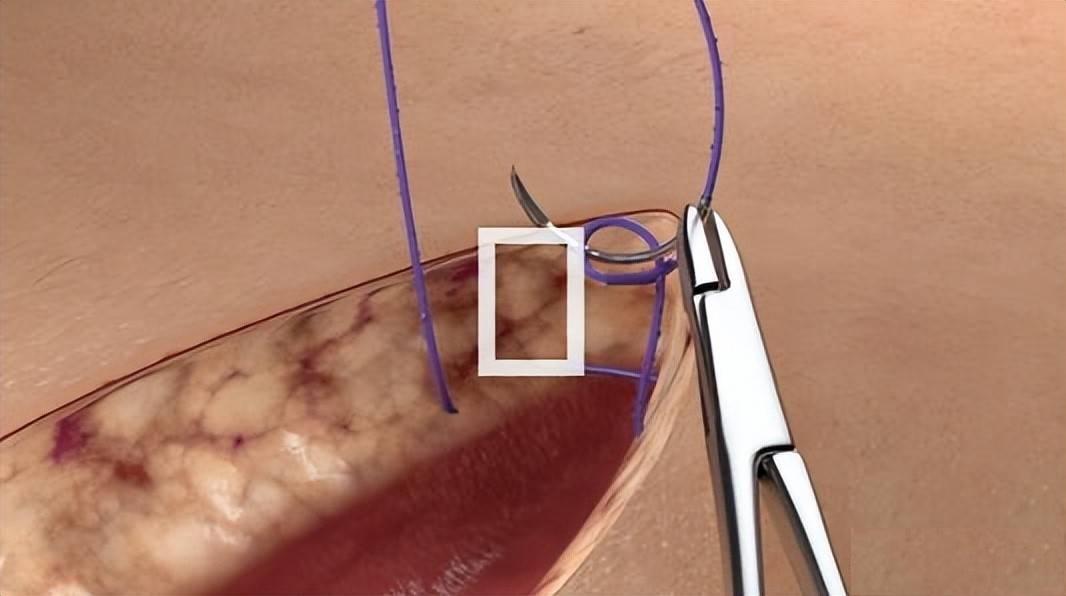 倒刺线的应用有多广泛？(倒刺縫線縫合)