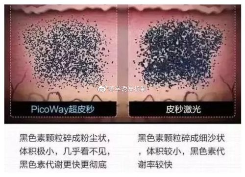 光子嫩肤、皮秒、超皮秒到底有什么区别？(激光祛斑嫩膚)