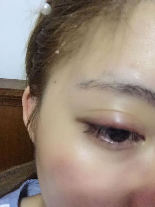 女子种假睫毛中招眶蜂窝织炎_过敏体质、易感人群不建议种睫毛(睫毛眼瞼女士)