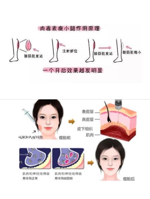 打瘦脸针、瘦腿针有哪些禁忌？一文读懂(註射中毒肉毒素)