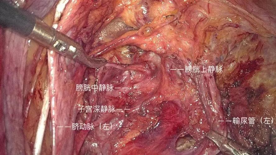 妇科腔镜手术 | 泌尿系统损伤(輸尿管膀胱損傷)