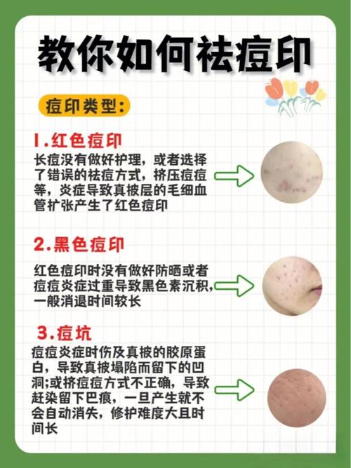 祛除痘印的方法有哪些？一起来了解一下(痘印深色很好)