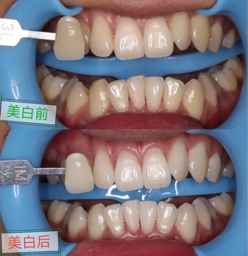 让牙齿变白_冷光美白、牙齿贴片靠谱吗？牙膏、洗牙的美白效果呢(牙齒美白冷光)