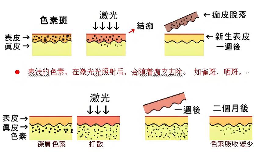 色斑做光子嫩肤效果好？带你揭秘光子嫩肤的3大步骤(嫩膚光子效果)