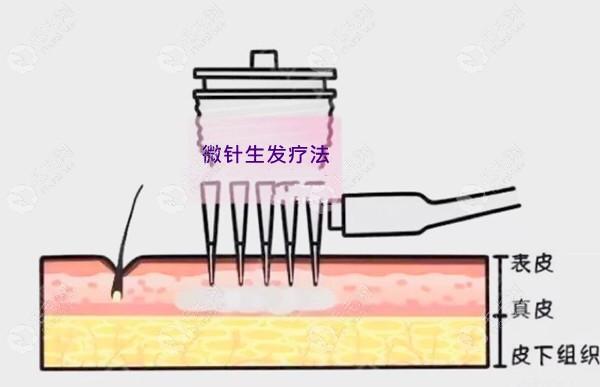 特需/国际医疗部系列——微针疗法_拯救您的“发际线”(特需您的發際)