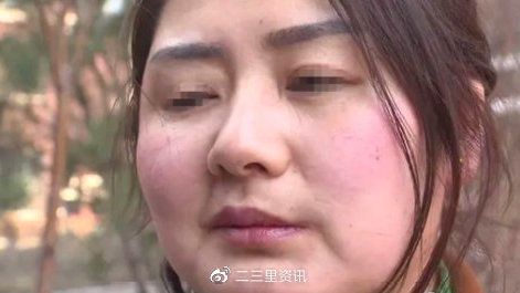 长春一女士在百乐欧尚美业容貌管理中心做“医美”_注射除皱针后_脸就歪了(女士註射管理中心)