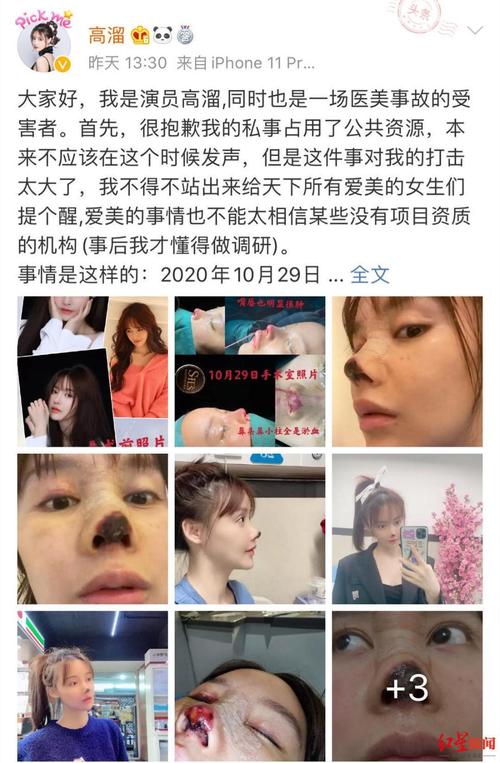 女星自曝整形失败遭毁容_鼻头变黑烂掉好可怕_无法拍戏差点自杀(整形毀容鼻頭)