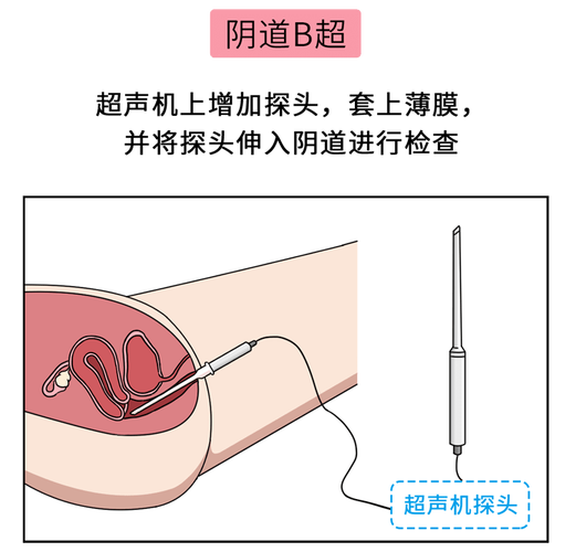 告别尴尬_了解这些妇科检查工具_让你更安心！(檢查輸卵管觸診)