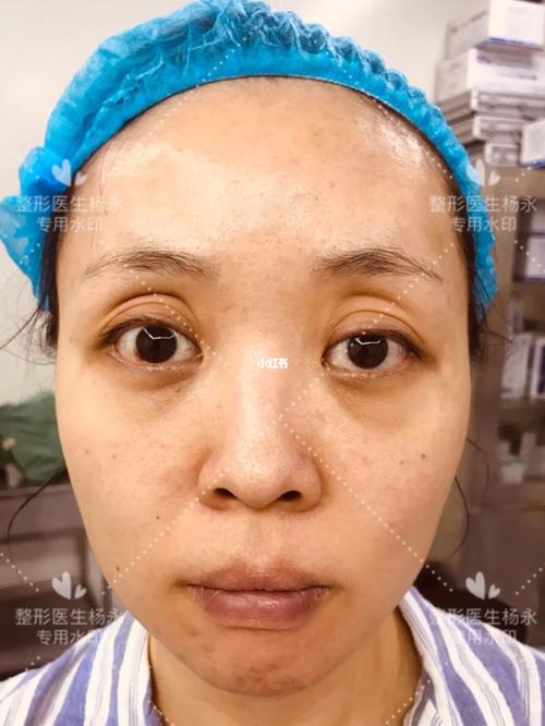 女子美容院脂肪填充出现结节 原址已成另一家诊所 律师：母公司在_可依法起诉(診所結節女士)