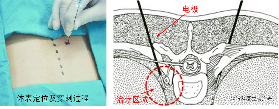 射频消融治疗子宫肌瘤最先进？医生告诉你_这个方法也有风险！(也有醫生治療)