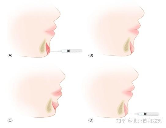 大师级病例讨论：王晓军教授团队改进肉毒毒素颏肌注射方法(註射肌註毒素)