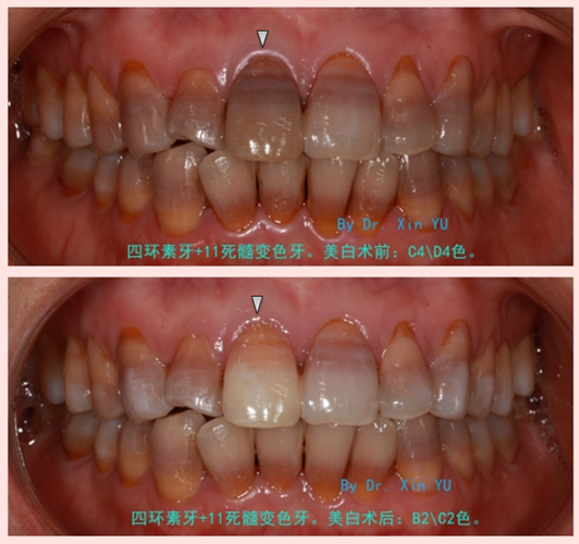 原来四环素牙还可以这样“洗”白？(覆蓋樹脂變色)