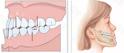 矫正“地包天”一定要趁早_不然面部生长可能会畸形！(矯治矯正上頜)