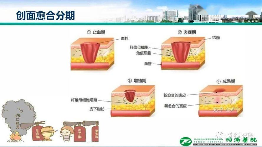 【4期专栏述评】急慢性创面的美容修复(創面修復美容)