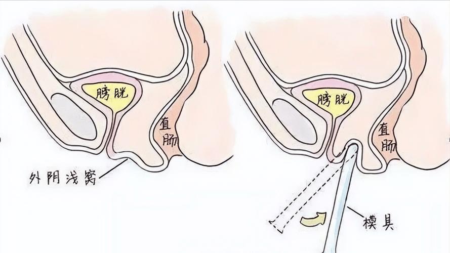 用口腔黏膜移植手术助其再造阴道(石女陰道黏膜)