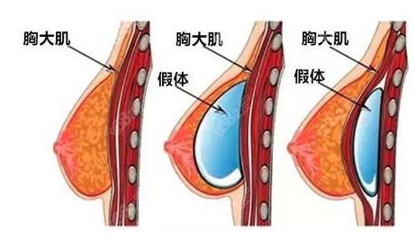 揭秘假体隆胸手术费用高低差异大的“猫腻”(假體隆胸整形)