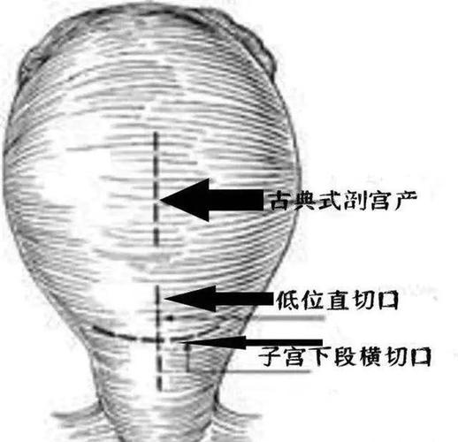 小小剖宫产切口竟有大讲究？到底哪个更好？(切口子宮剖宮產)