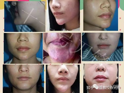 48岁女子打美容针后_表情僵硬、脸上长赘肉_取出生长因子增生物(美容註射取出)