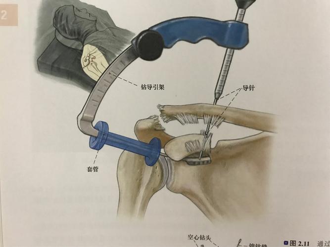 锁骨远端骨折肩关节镜下微创固定也可以又快速又精准！(肩關節鎖骨骨折)