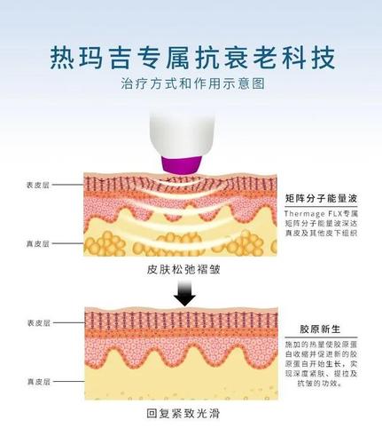 你真的了解热玛吉、热提拉吗？谈谈始于1920年代的射频美容(射頻美容解熱)