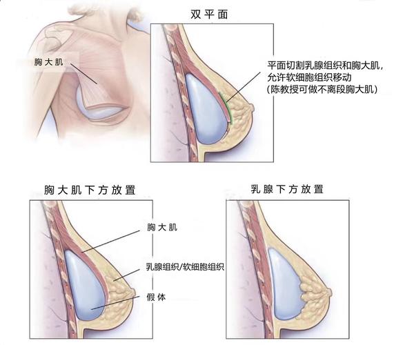 隆乳术的形体设计(假體乳房選擇)