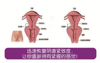 美容科普-私密线雕_让你重新拥有青春感受(術後私密陰道)