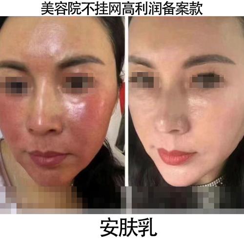 美容院护理后皮肤敏感？如何避免自己变成激素脸？(激素美容院美白)