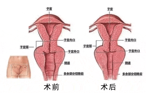 目前整形美容产品的项目形式(目的整形陰道)