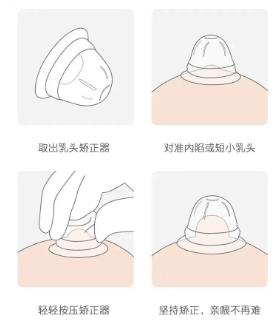 一种遮罩式乳头凹陷纠正器的设计与应用(乳頭註射器凹陷)