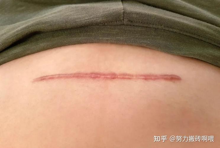 产后宝妈求助：剖腹产疤痕增生怎么办？整形医生来支招(疤痕增生醫生)