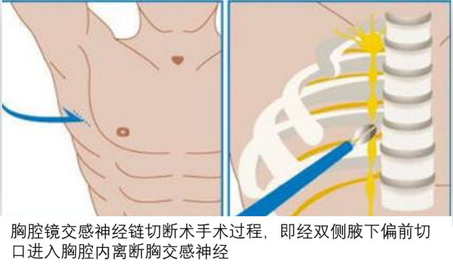 27岁男子一年四季掌心汗如雨下 微创手术帮他搞定顽疾(交感神經胸外科手術)