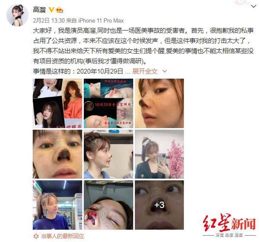 长春市第二医院职业病科高雁主任：爱美要适度 别让美容变毁容(職業病祛斑美白)