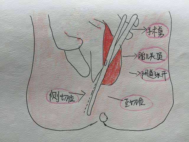 产后常见问题有哪些 应如何面对？(產後傷口會陰)