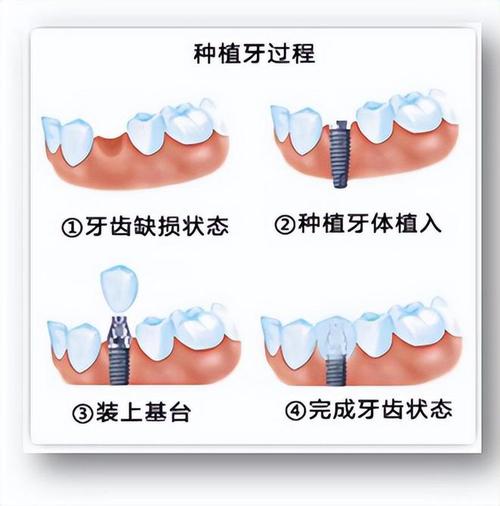 镶牙费用太高患者叫苦：为何不纳入医保？(醫保鑲牙種植)