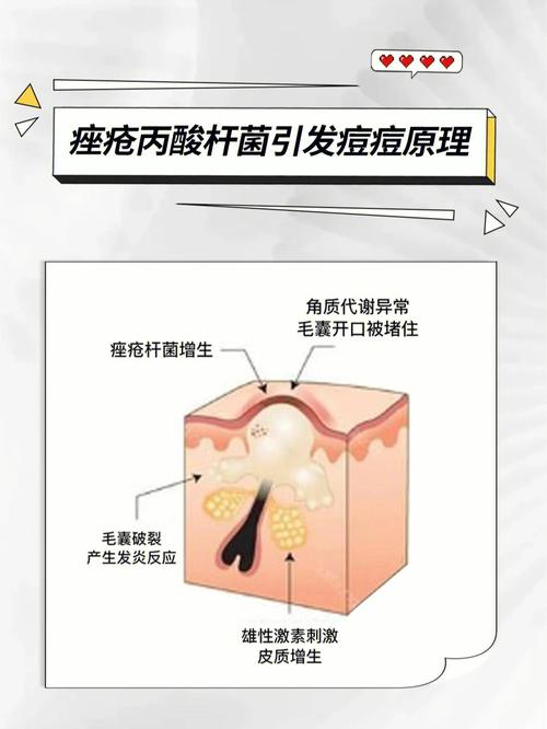 有痤疮别用蒸脸仪(痤瘡皮脂腺毛囊)