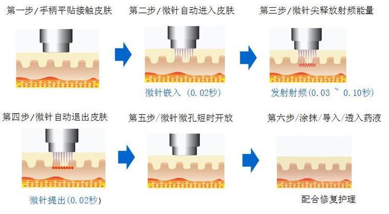 【科普】皮肤针的操作方法与注意事项(皮膚局部操作方法)