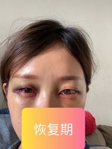 拉皮、祛眼袋可年轻十岁？女子术后伤口发炎、视力模糊(拉皮眼袋術後)